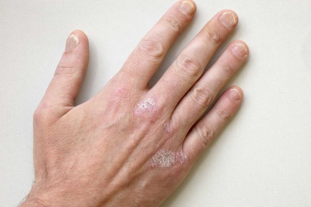 Psoriasis en manos de un hombre, tratada con crema Keramin.