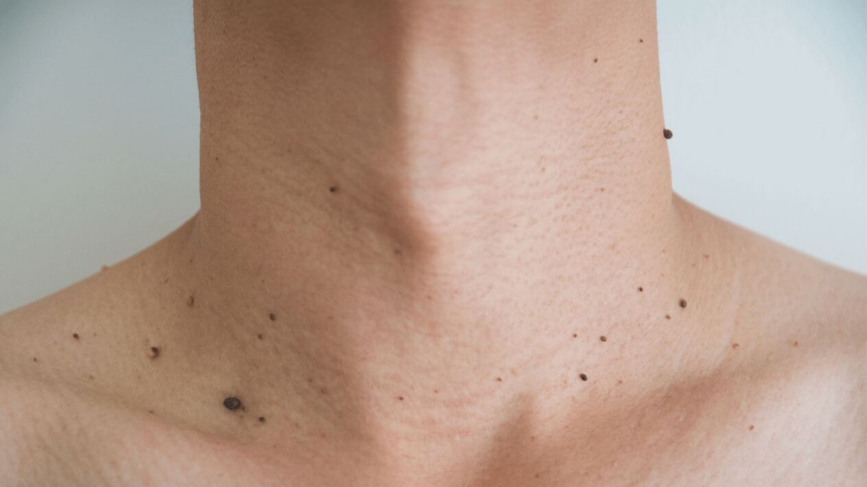 Tratamiento con crema de queramina para papilomas en cuello y pecho.