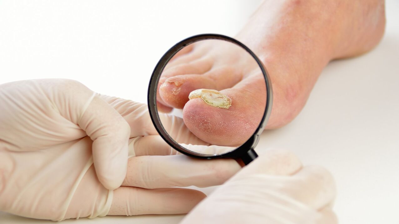 Tratamiento de hongos en las uñas con crema de queramina.