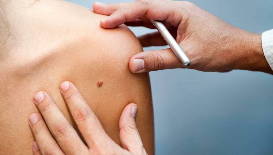 Dermatólogo examina a un paciente con papiloma